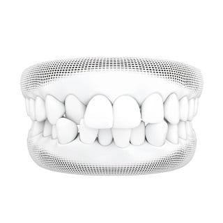 3D wireframe model of crowded teeth