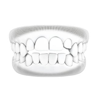 3D wireframe model of open bite teeth