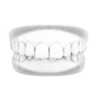 3D wireframe model of overbite teeth
