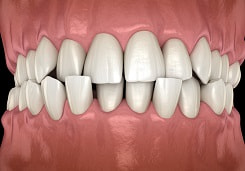 Digital illustration of teeth with crossbite