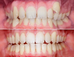 Before and after comparison of crowded teeth, fixed with Invisalign