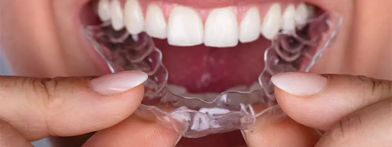 Close-up of a person inserting Invisalign