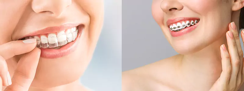 Side-by-side images of a woman with Invisalign and another woman with traditional braces, both smiling