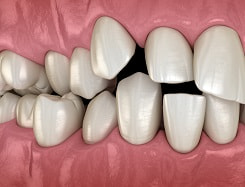 Digital illustration of teeth with misaligned teeth
