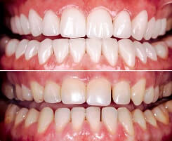 Before and after comparison of orthodontic relapse, fixed with Invisalign