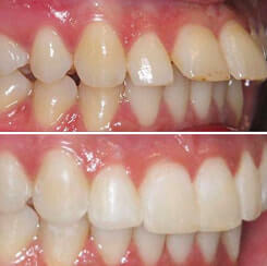 Before and after comparison of overbite teeth, fixed with Invisalign