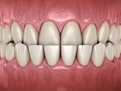 Digital illustration of teeth with underbite